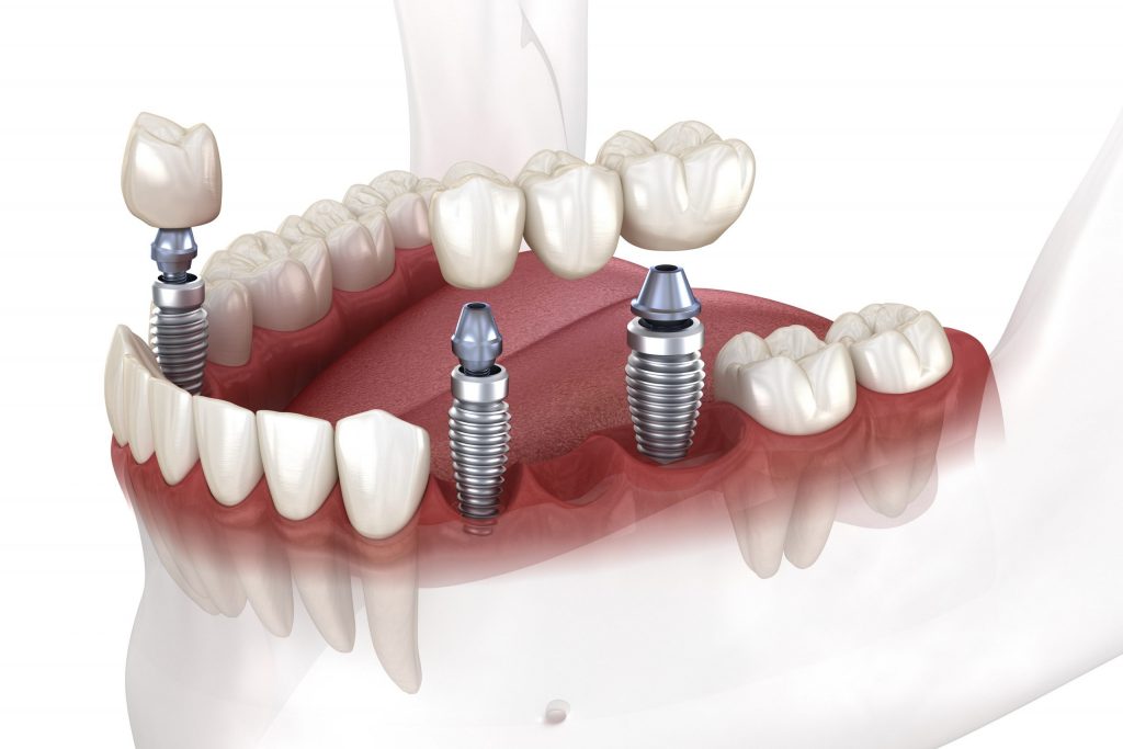 implantes dentarios clinica almirante reis 70